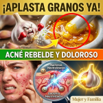 ¿Acné Rebelde y Cara Destrozada? Aplasta los Granos con la Pasta “Antibiótica” de Ajo y Cúrcuma