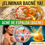 ¡El Secreto Clínico Revelado! Los Minutos Exactos y la Proporción Perfecta para Eliminar el Acné de Espalda (Bacné)