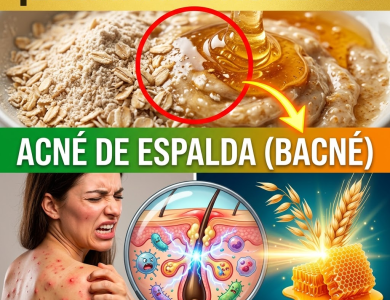 ¡El Secreto Clínico Revelado! Los Minutos Exactos y la Proporción Perfecta para Eliminar el Acné de Espalda (Bacné)