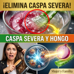 ¡El Secreto Clínico Revelado! La Proporción Exacta y los Minutos Precisos para Eliminar la Caspa Severa sin Dejar Olor a Cebolla