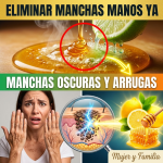 El Secreto de la “Doctora Limón-Miel”: La Proporción Exacta y los 12 Minutos Precisos para Borrar Manchas de las Manos (¡Peligro si lo haces mal!) El Secreto de la “Doctora Limón-Miel”: La Proporción Exacta y los 12 Minutos Precisos para Borrar Manchas de las Manos (¡Peligro si lo haces mal!)