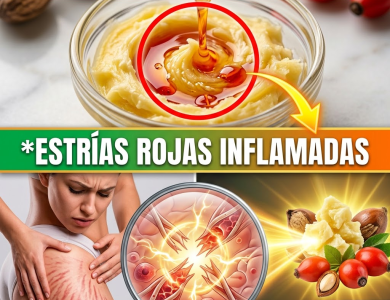 El Secreto de la “Señora Karité”: La Proporción Exacta y los 15 Minutos Precisos para Borrar las Estrías Rojas (¡Peligro si lo haces mal!) El Secreto de la “Señora Karité”: La Proporción Exacta y los 15 Minutos Precisos para Borrar las Estrías Rojas (¡Peligro si lo haces mal!)