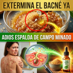 ¡¿Tienes la Espalda como “Campo Minado”?! Elimina el Bacné y las Manchas con el “Exterminador” Natural